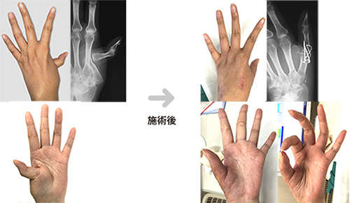 関節固定術と関節形成術のどちらが適任ですか?