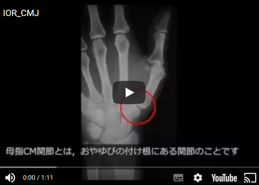 母指CM関節形成術